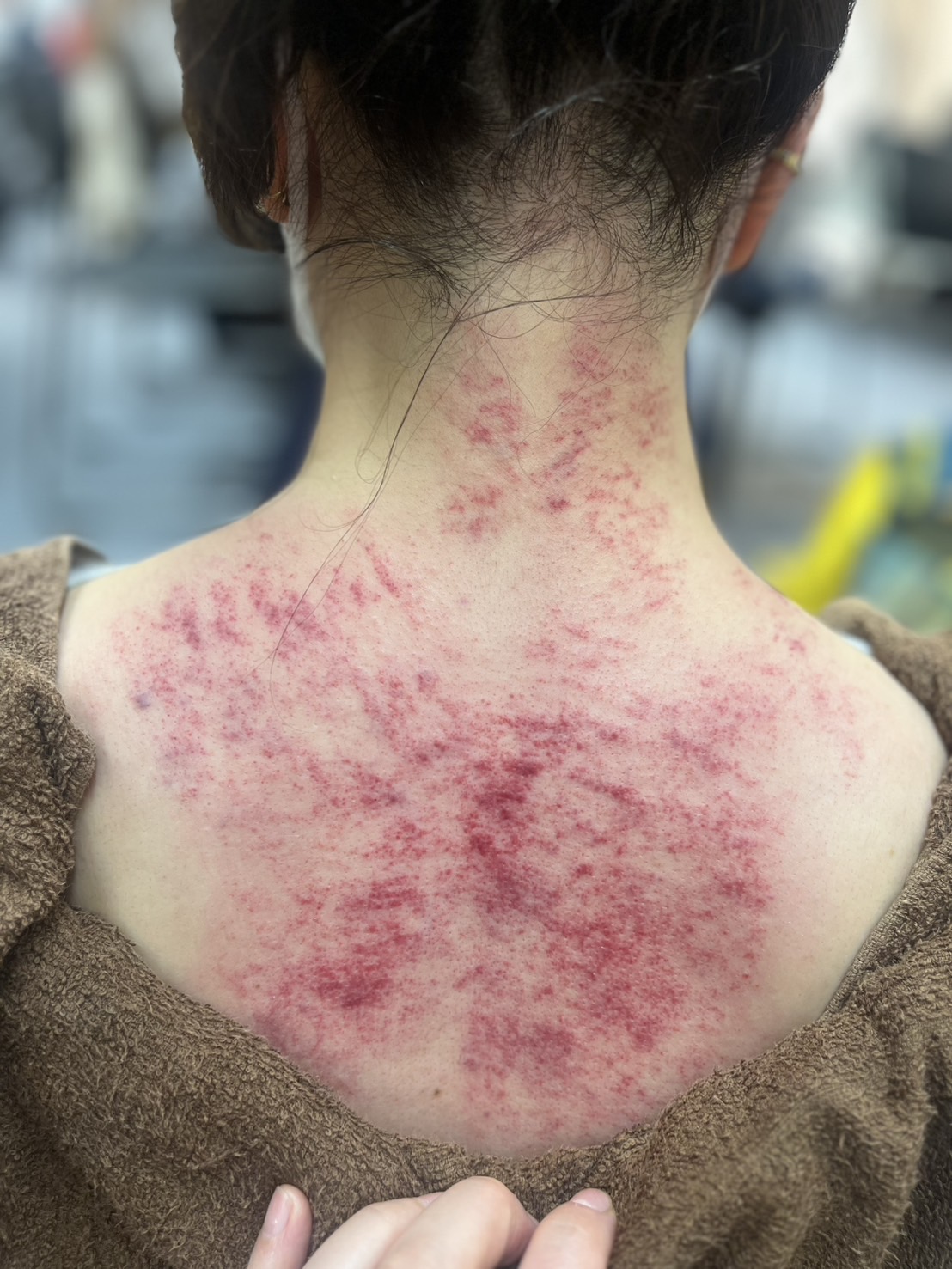 茶色のタオルを肩にかけた人物の首から背中にかけて、かっさ施術による赤みやうっ血が広がっている様子。施術者の手が肩と背中に添えられ、丁寧に施術を行
物と看板があり、落ち着いた室内での施術風景。