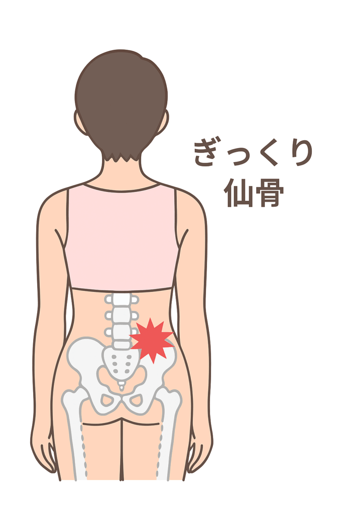後ろ姿の人物の腰から骨盤にかけてのイラスト。仙腸関節の位置に赤い痛みマークが描かれており、“ぎっくり仙骨”という文字が添えられている。仙骨まわりの急性痛を示す図解。